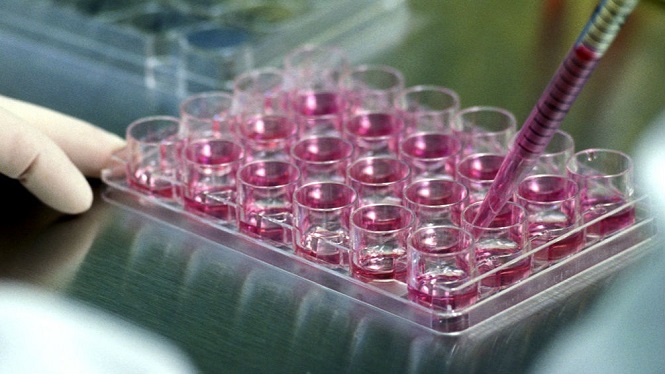 Esclerosis múltiple: Respaldan el uso de células madre del cordón umbilical en pacientes